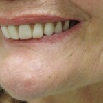 before dentures