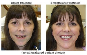 before and after denture picture