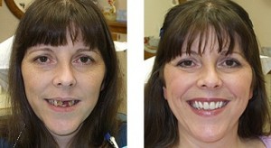before and after denture picture