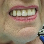 before denture picture