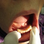 dental implants for partial denture