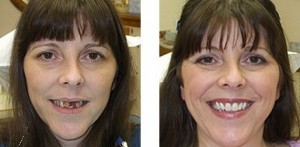 Cosmetic Dentures before and after