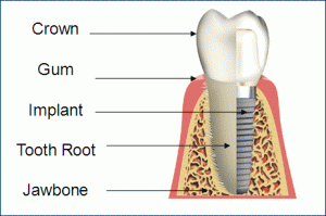 Portland dental implants